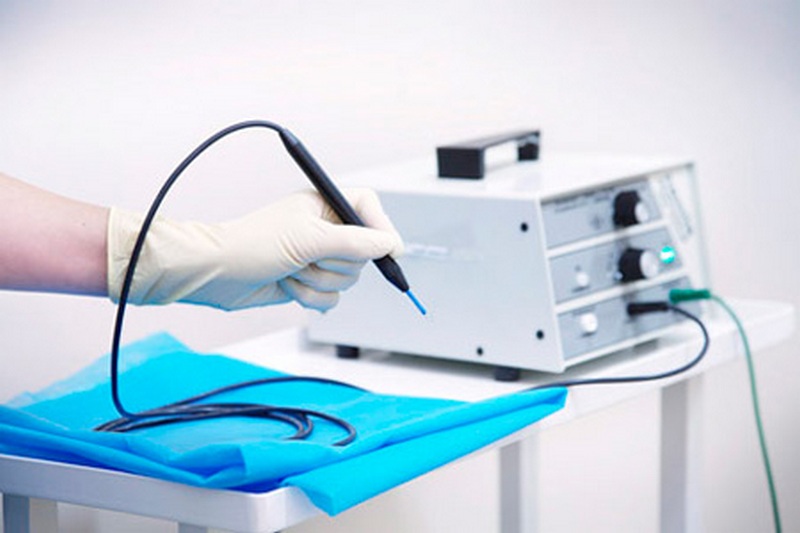 Лечение анальной трещины при помощи аппарата Сургитрон