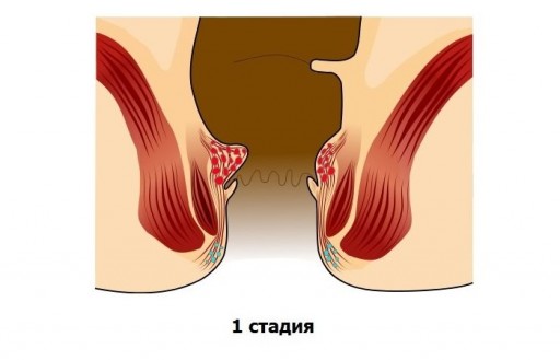 Терапевтическое лечение геморроя на ранних стадиях