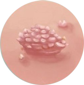 Анальная кондилома