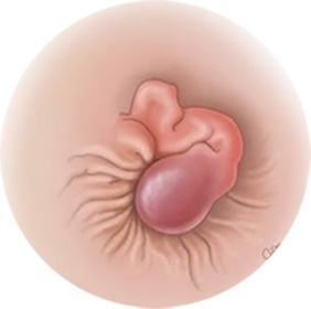 Анальный полип