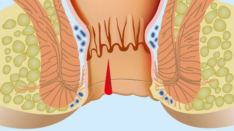 Анальная трещина: симптомы, причины, последствия