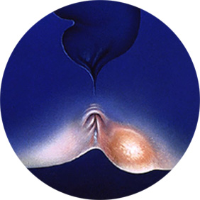 Парапроктит