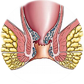 Тромбоз геморроидальных узлов