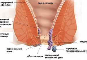 Лечение геморроя в Махачкале