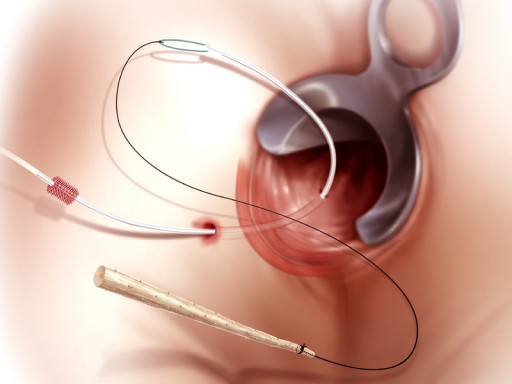Что нужно знать о парапроктите?