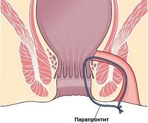 Парапроктит: симптомы и лечение
