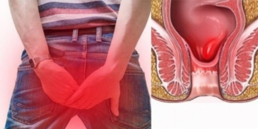 Опасен ли геморрой и нужно ли его лечить?