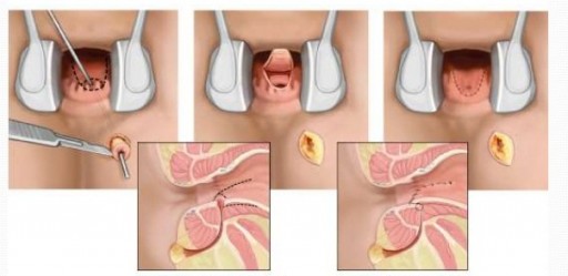 Заболевания прямой кишки