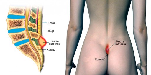 Симптомы кисты копчика