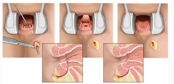 Заболевания прямой кишки