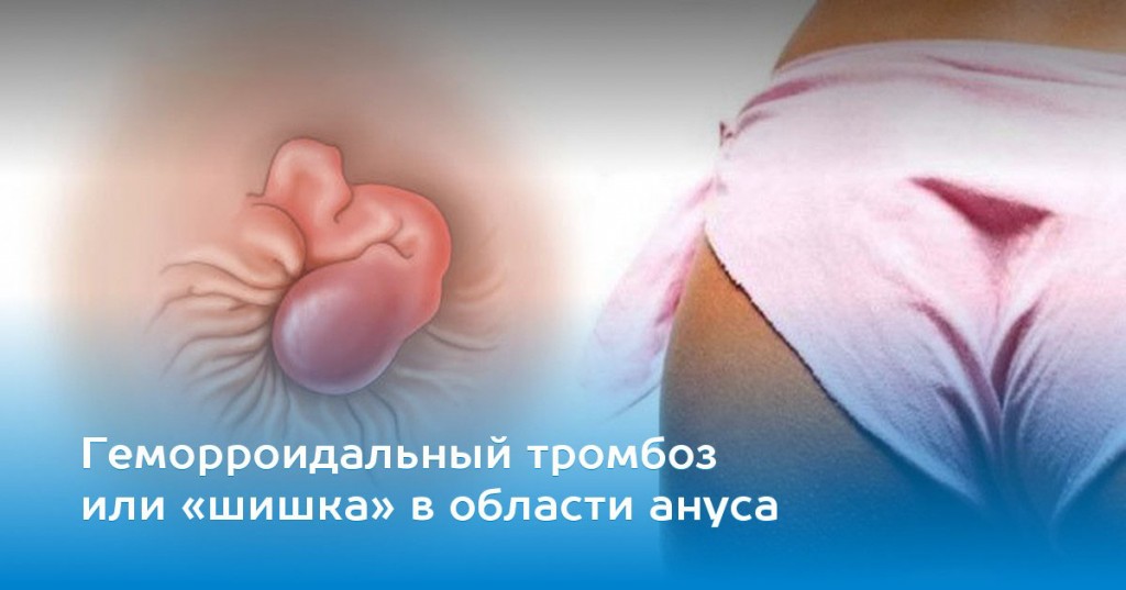 Геморроидальный тромбоз или «шишка» в области ануса: опасно это или нет