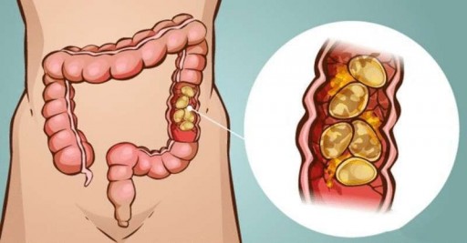 Удаление каловых камней в Дагестане