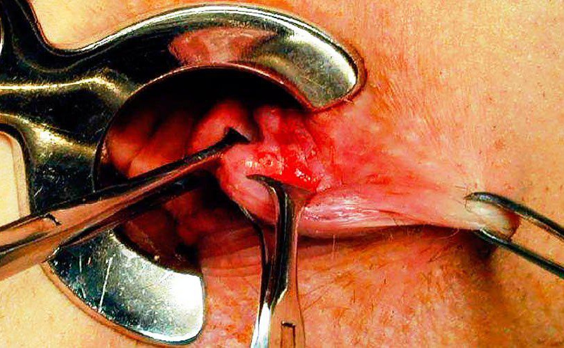 Геморроидэктомия